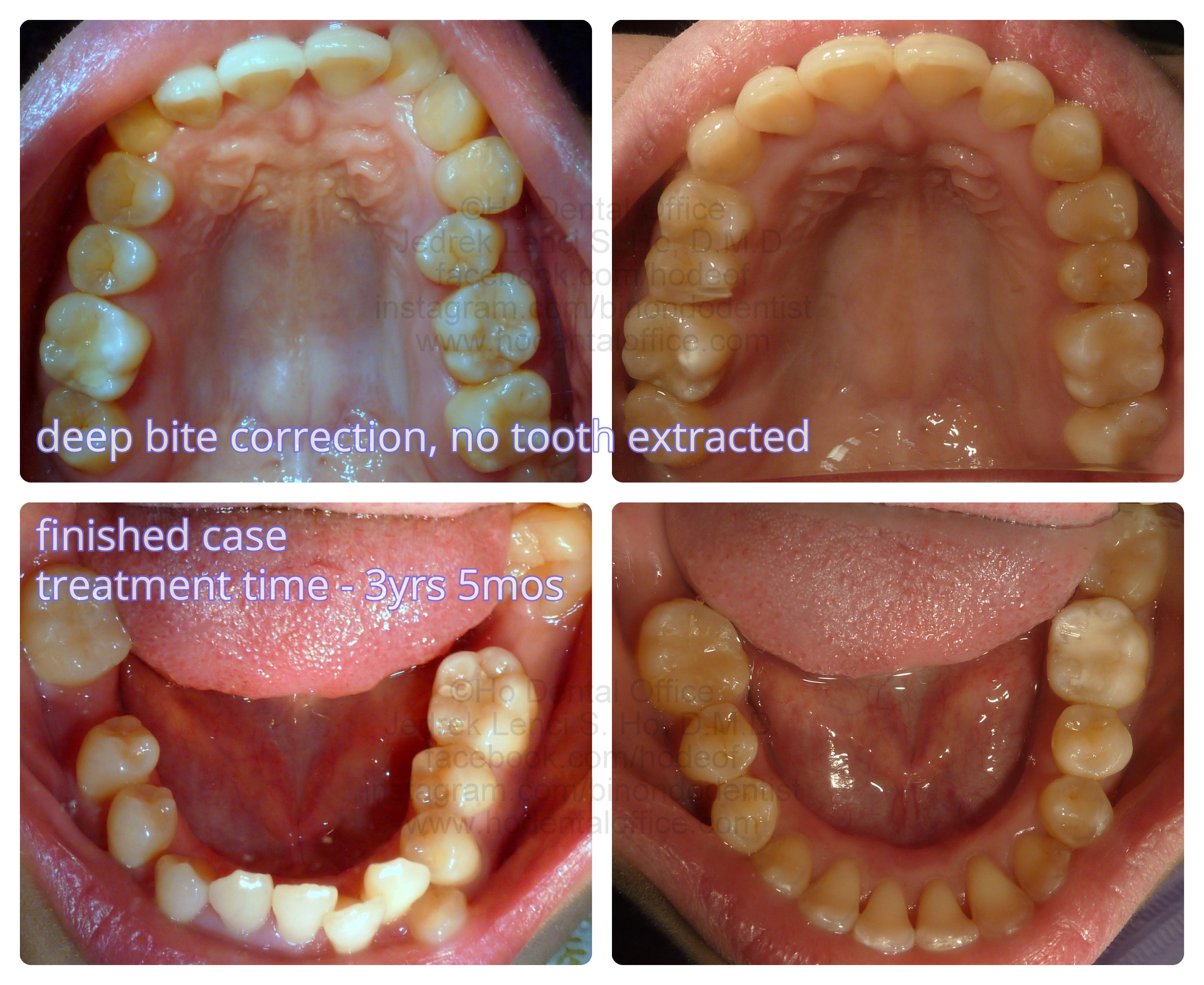 deep bite orthodontics case occlusal view before and after