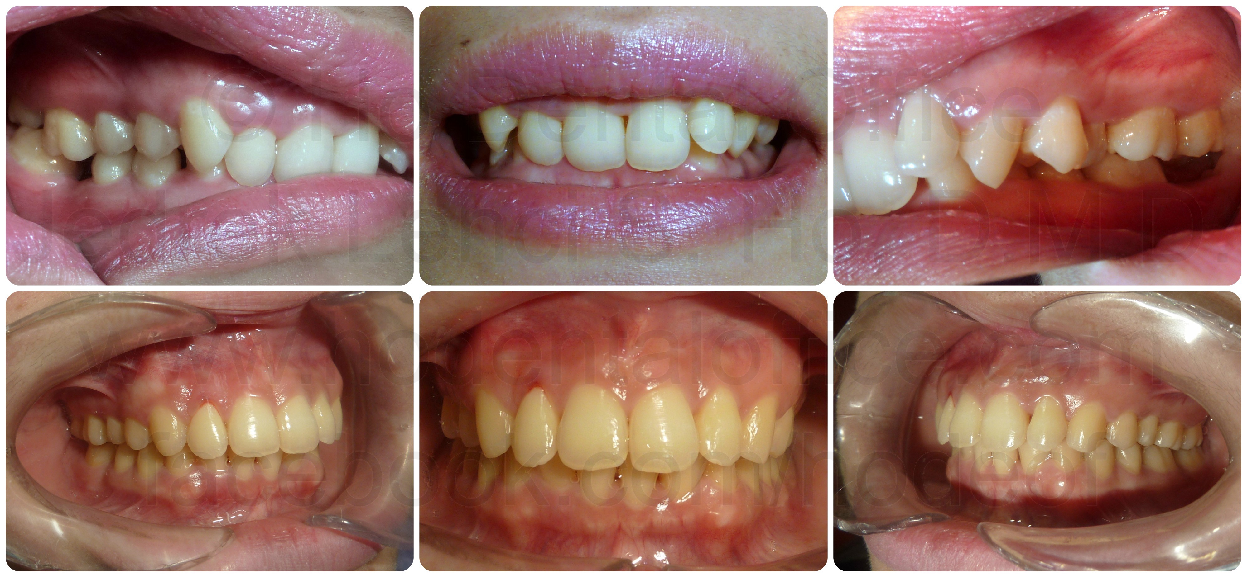 deep bite orthodontics case front and side view before and after