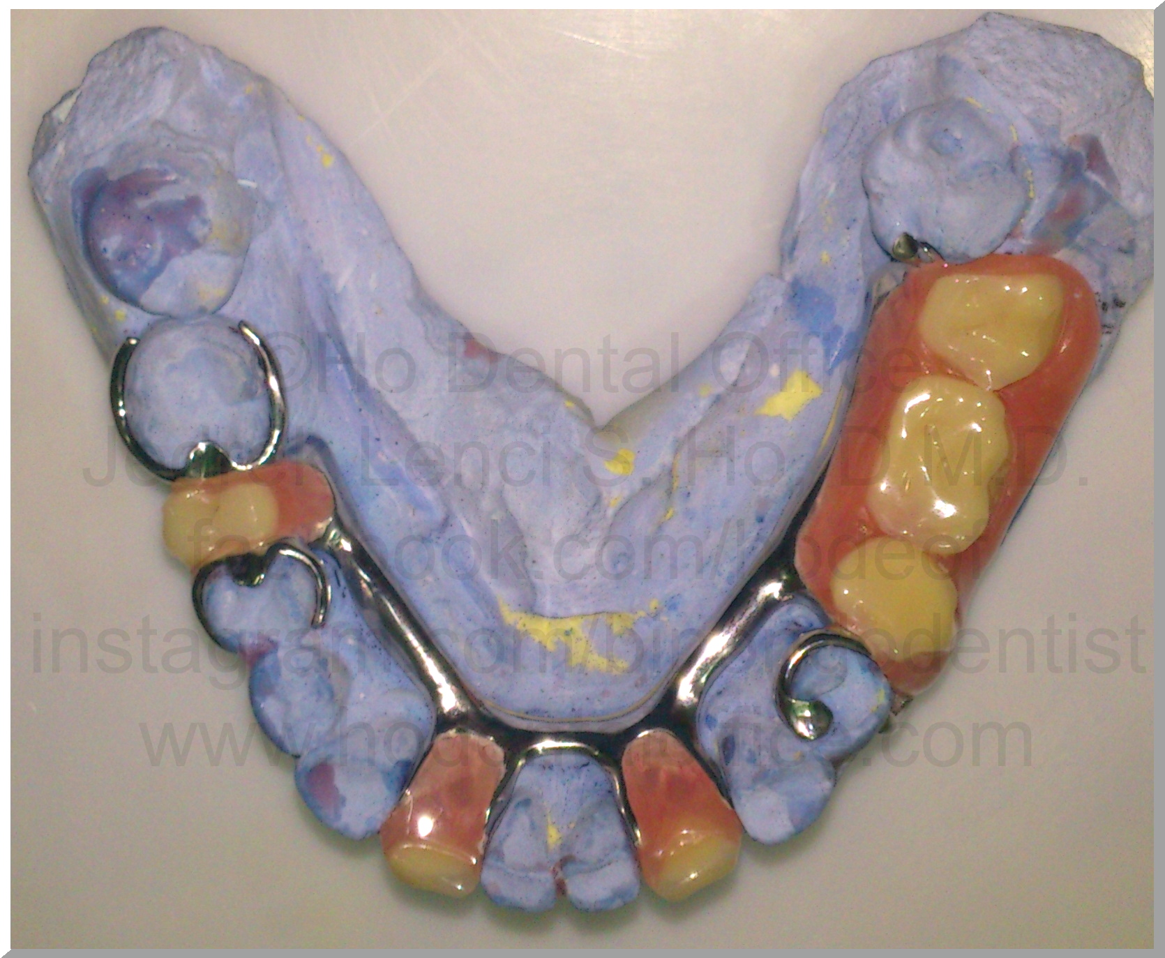 R.Tan lower occlusal bruxism 10-14-2013