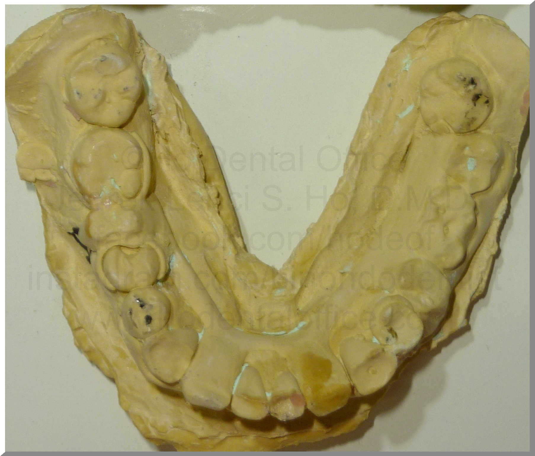 R.Tan lower occlusal bruxism 12-23-2015