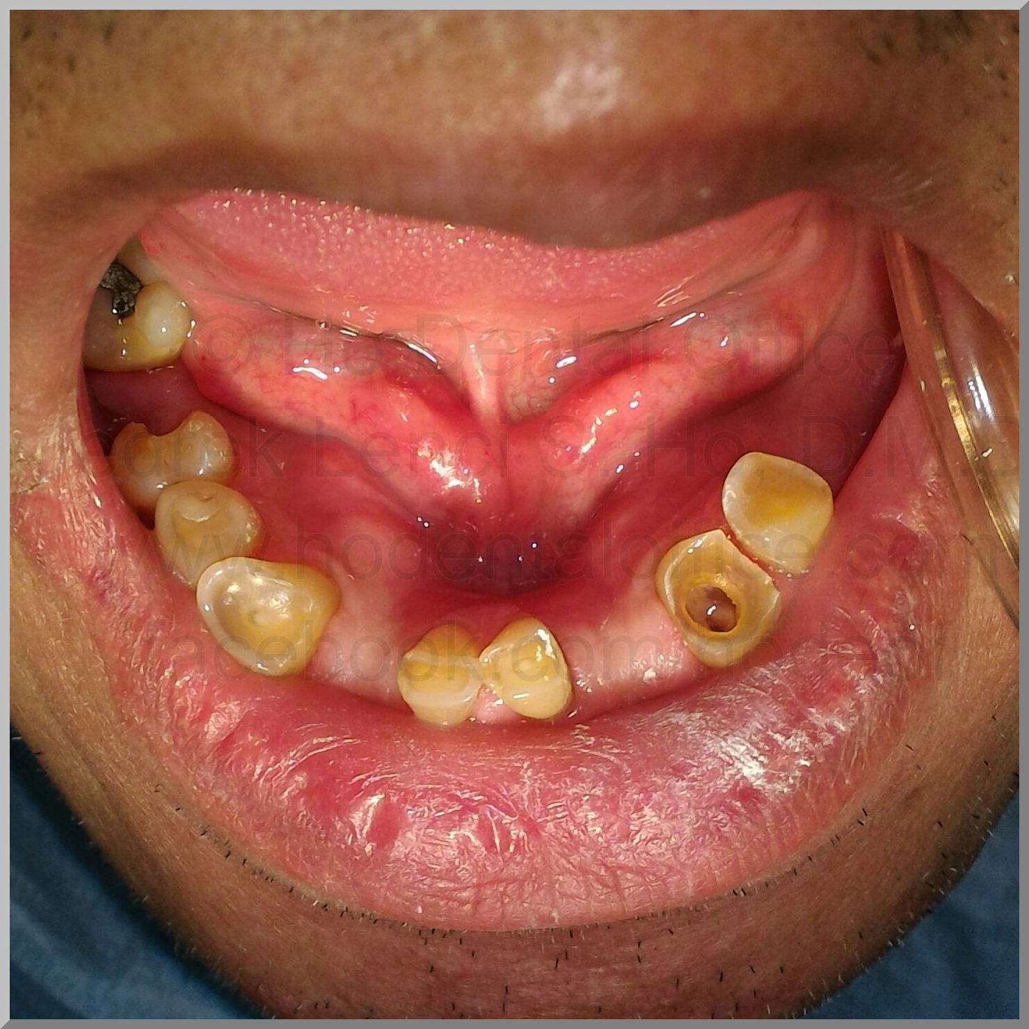R.Tan lower occlusal bruxism 4-18-2017