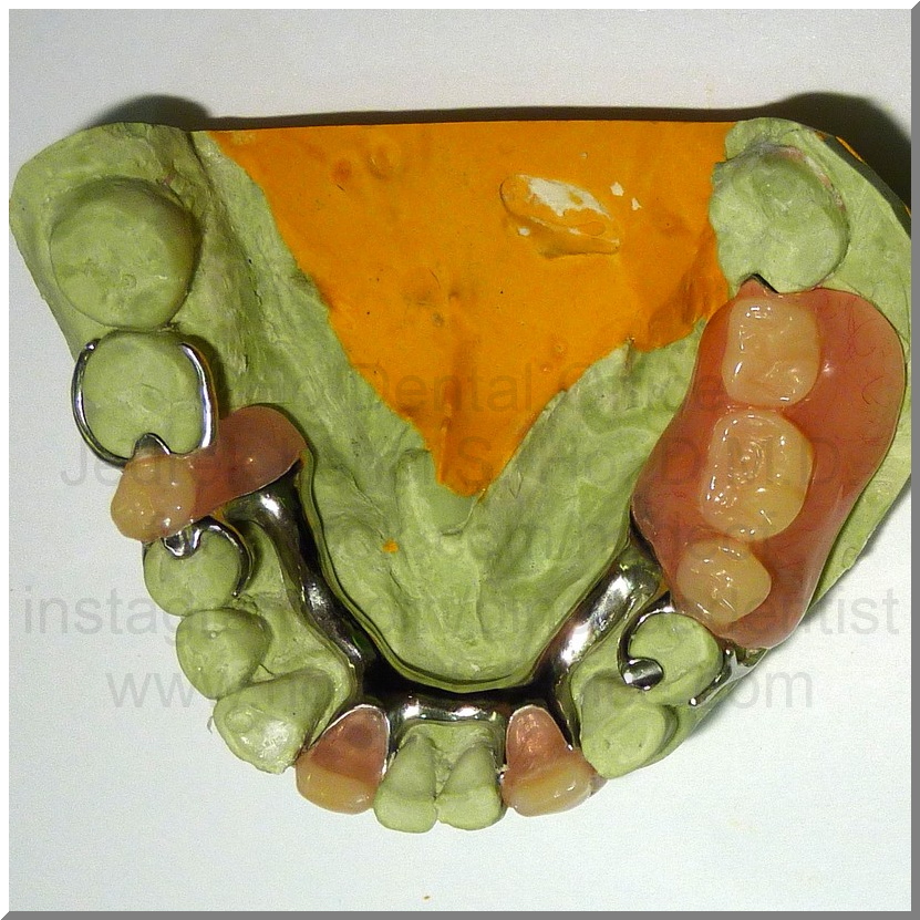 R.Tan lower occlusal bruxism 6-2-2011