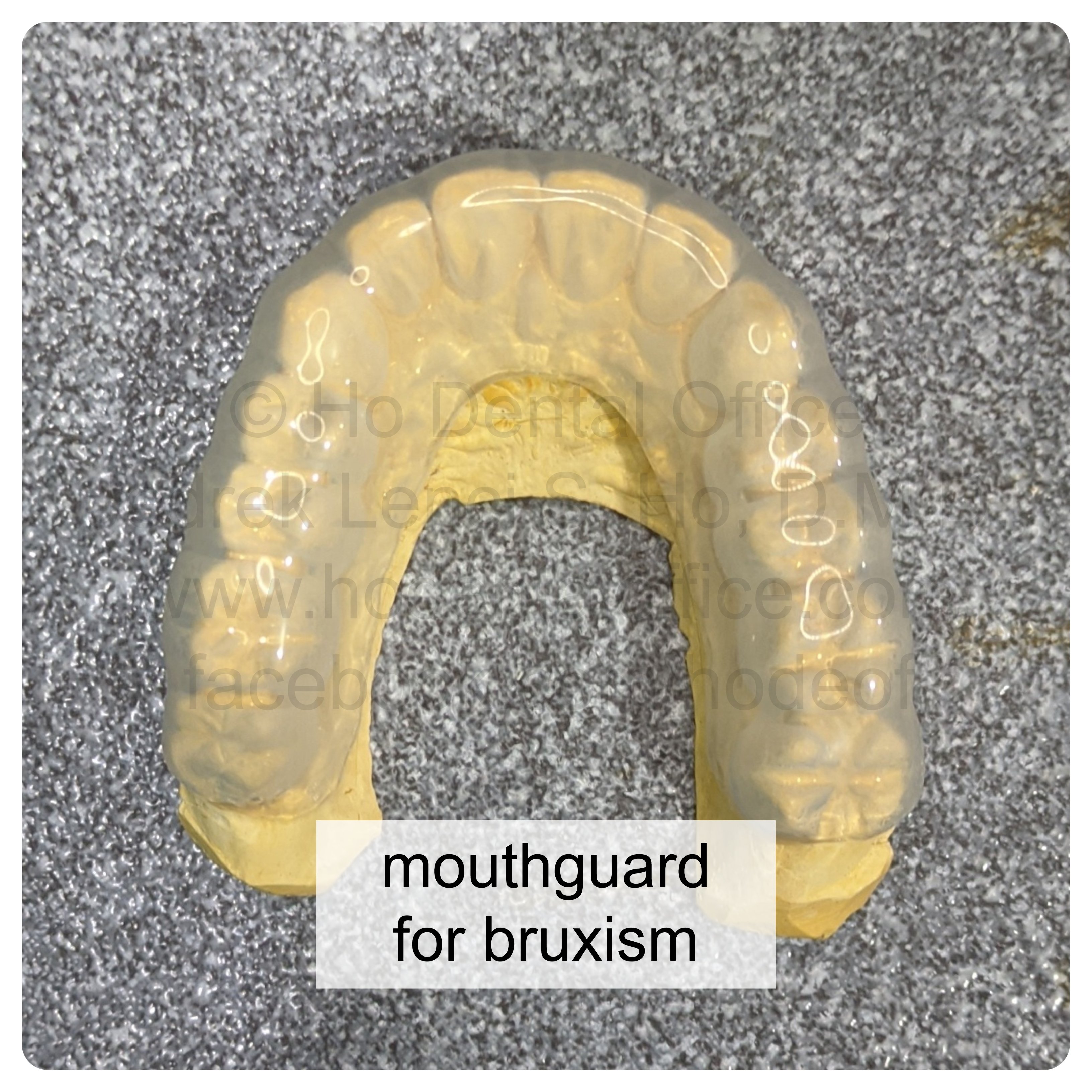 rubberrized mouthguard for bruxism or nightgrinding