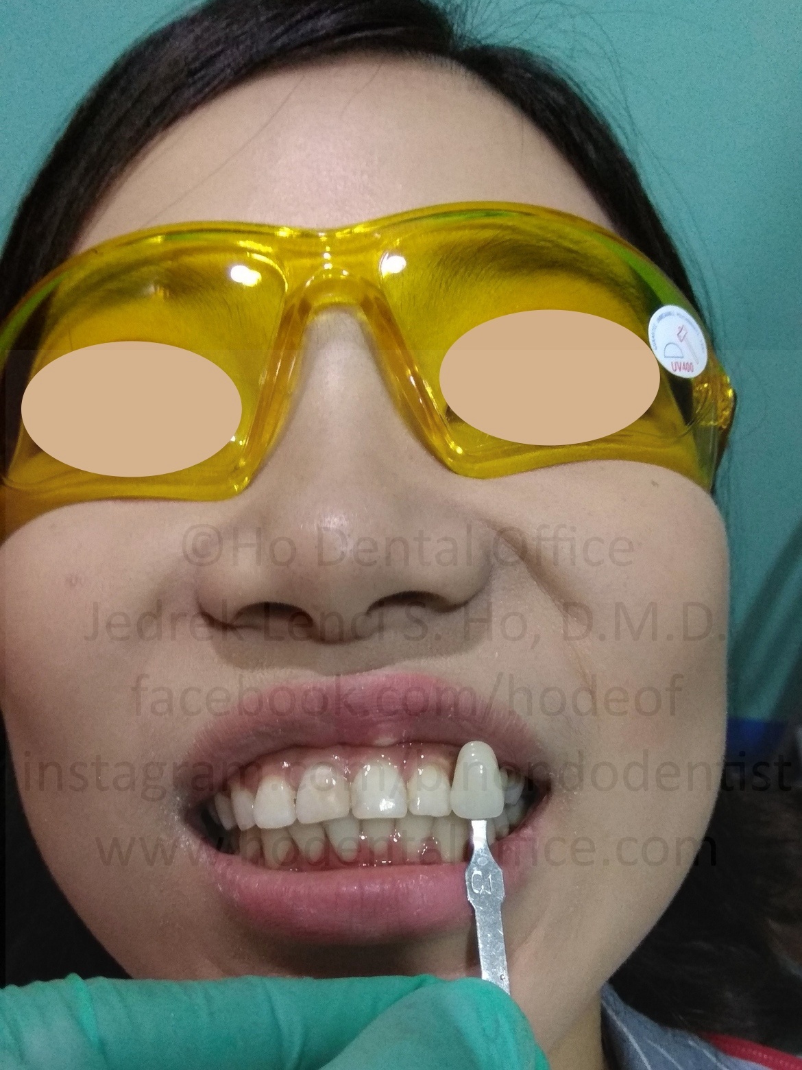 tooth shade determination prior to and after teeth whitening