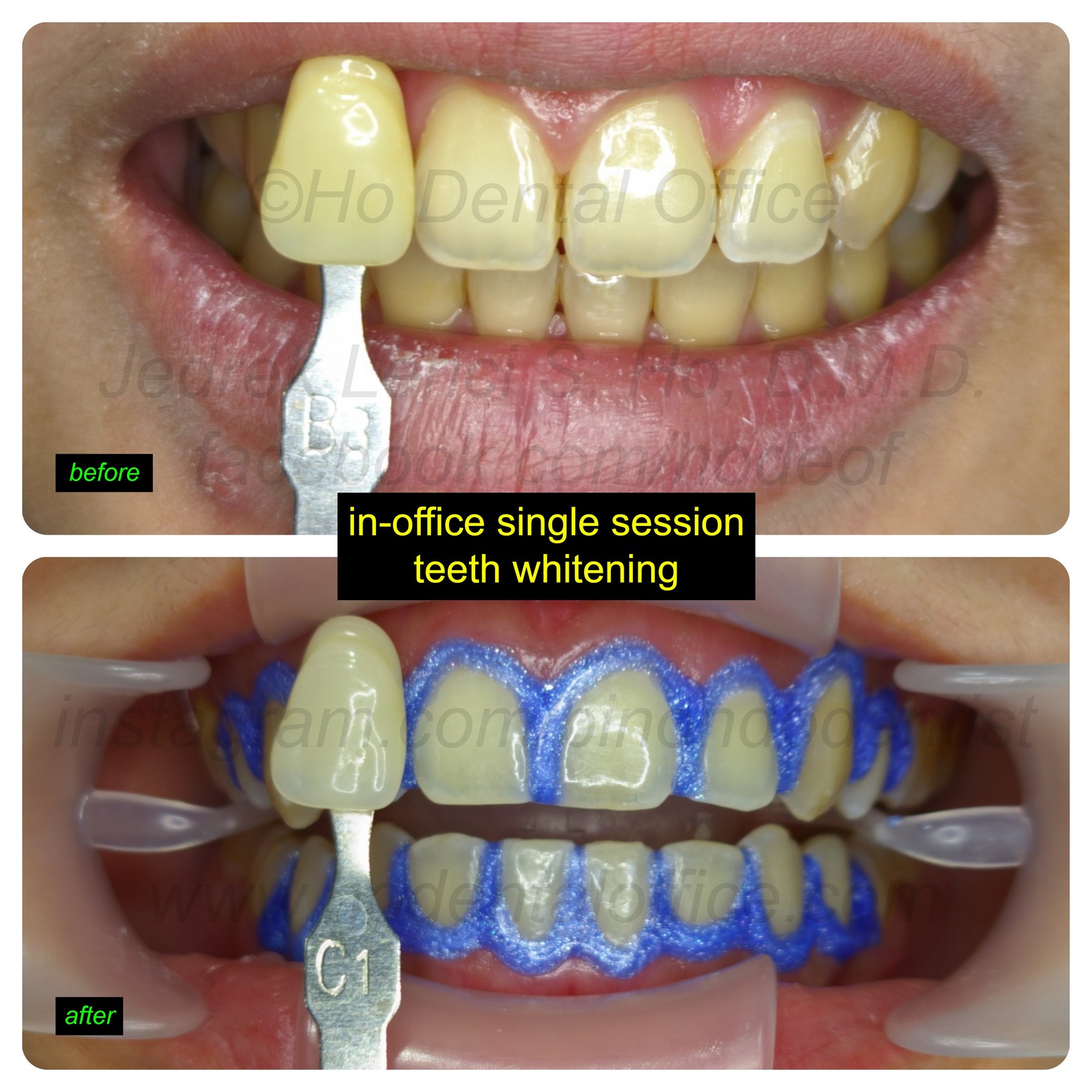 typical in-office whitening results - 5 shades lighter from B3 to C1