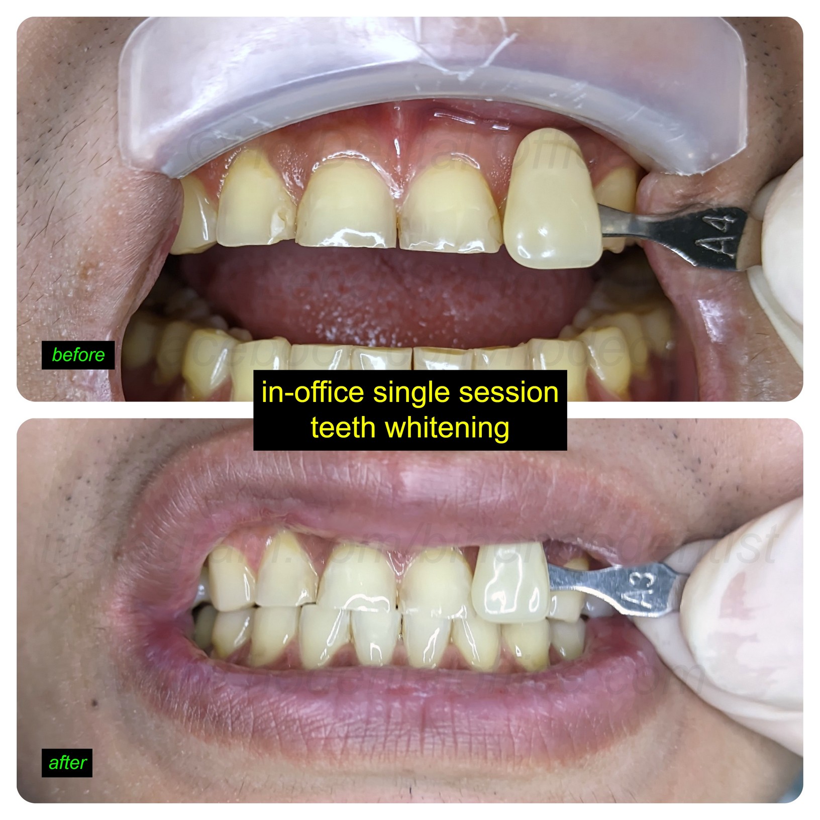 typical in-office whitening results - 6 shades lighter from A4 to A3