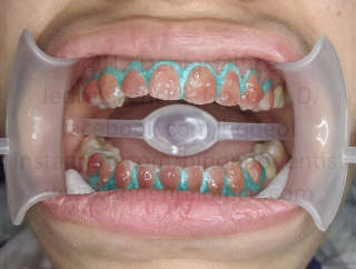 application of whitening solution on teeth and gingival protector on the gums