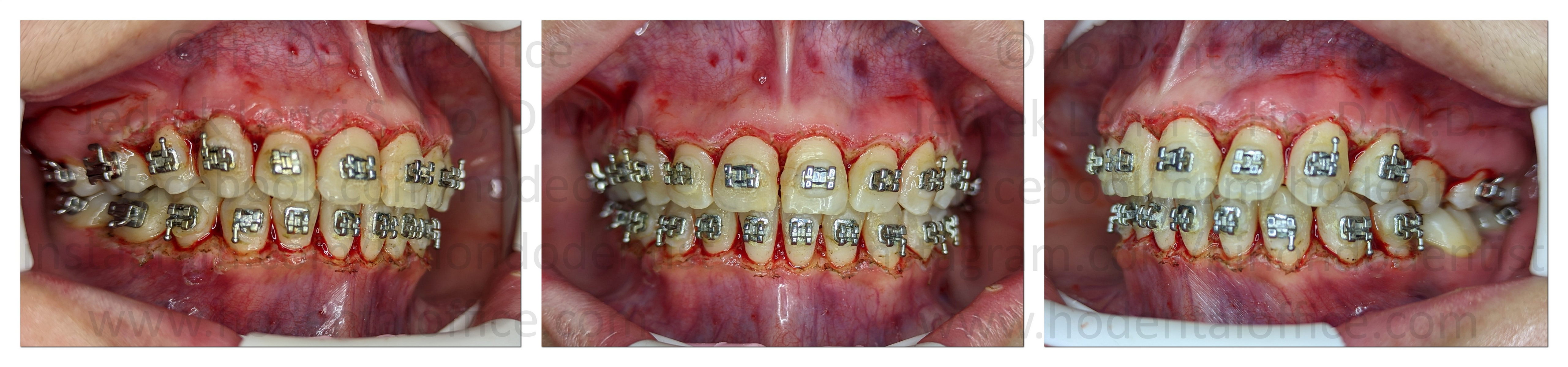 patient on the day of the surgery post-op Nov 14, 2022