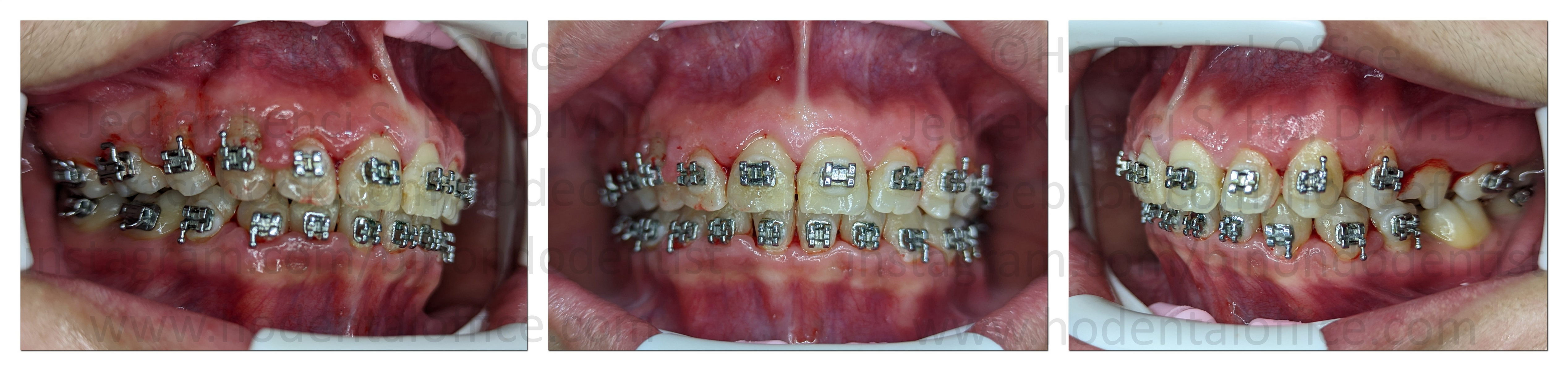 patient on the day of the surgery Nov 14, 2022