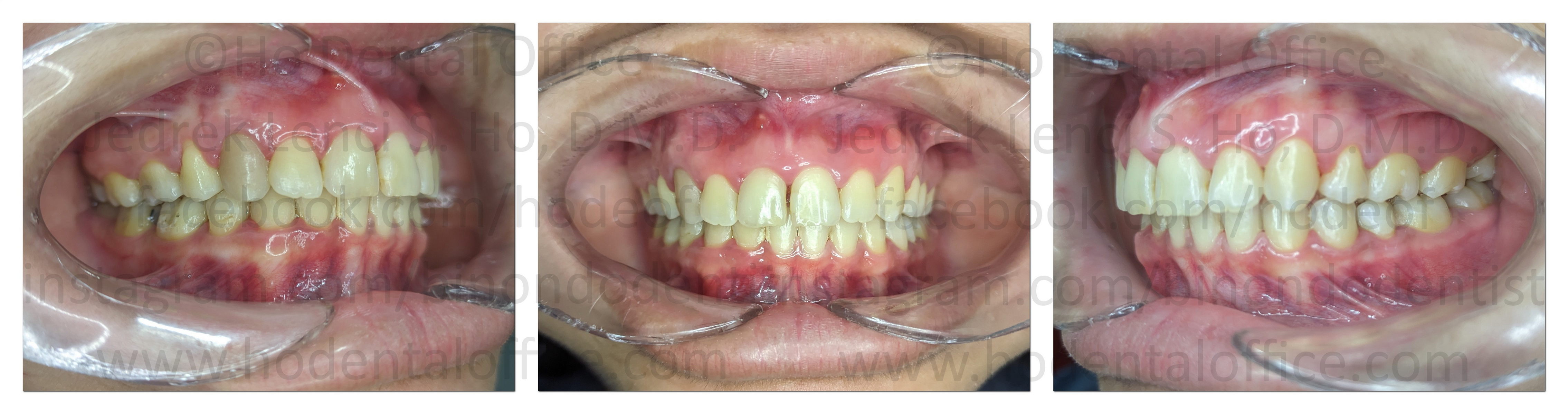 patient after 3 years post-op seen on Aug 8, 2025