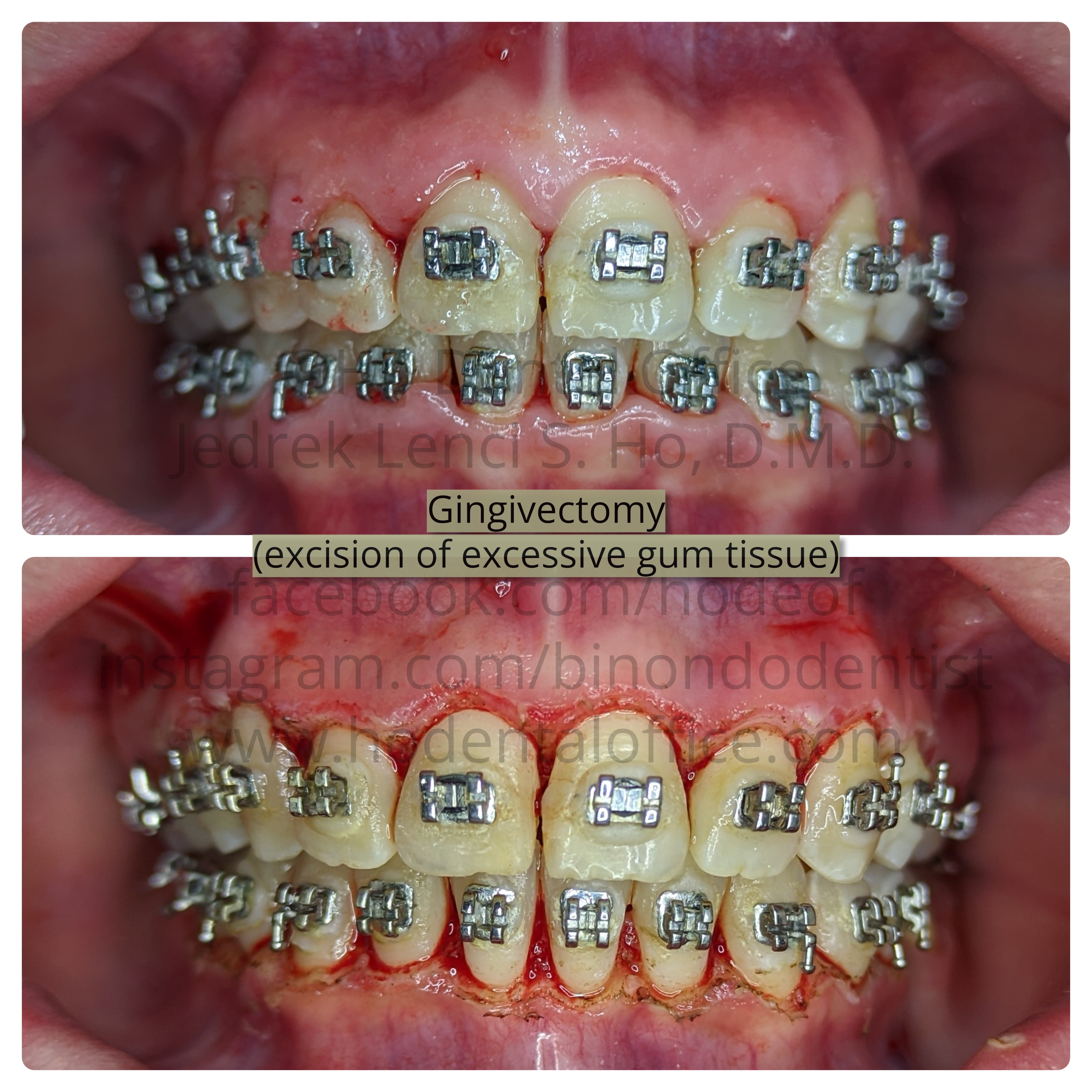 Gingivectomy and Gingivoplasty - orthodontic patient's case