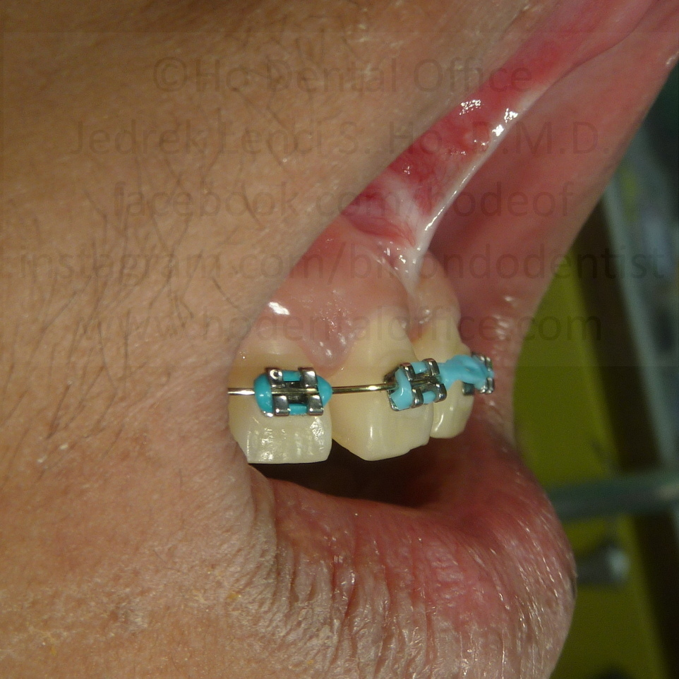 surgical site after 3 months - June 2017