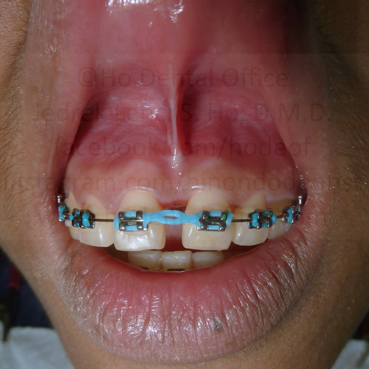 surgical site after 3 months - June 2017