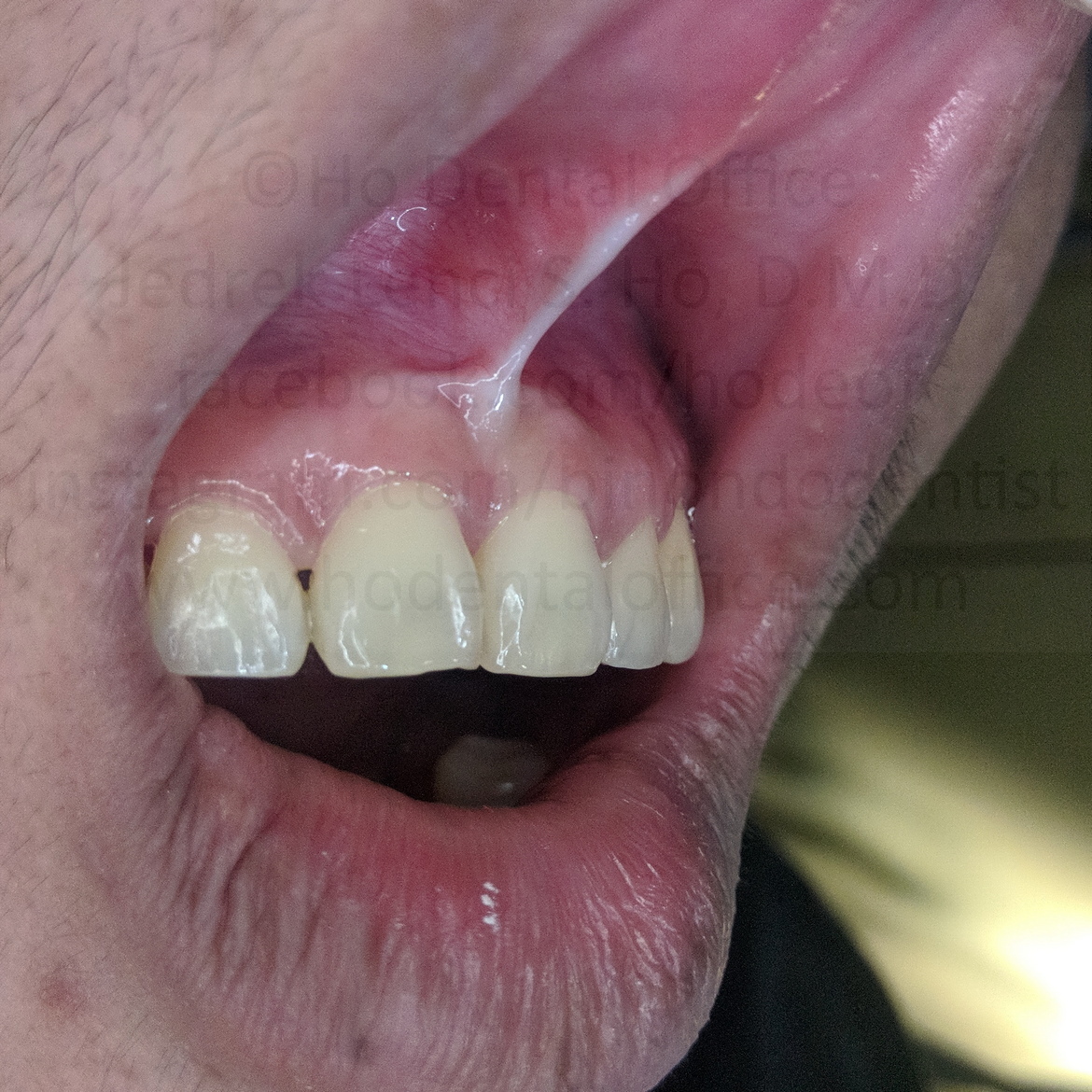 surgical site after 3 years - Nov 2020