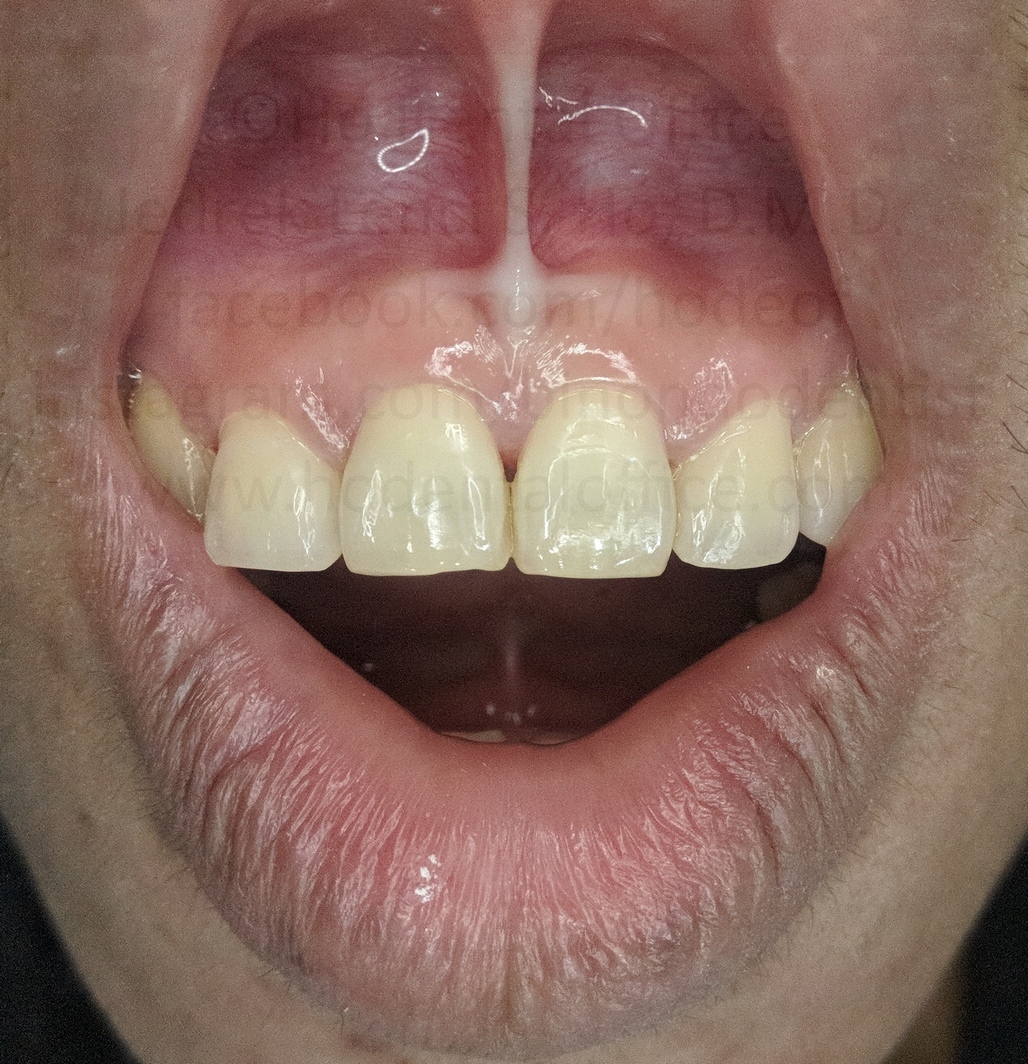 surgical site after 3 years - Nov 2020