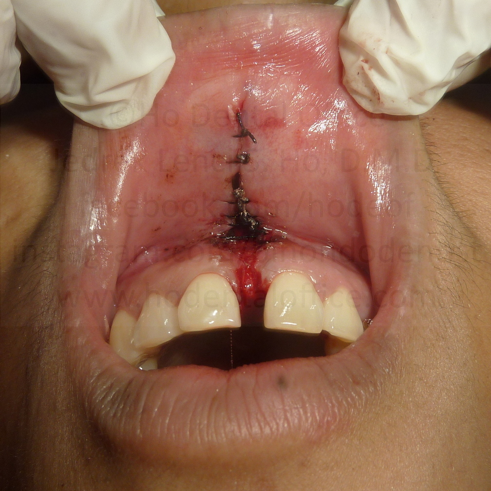surgical site was sutured afterwards
