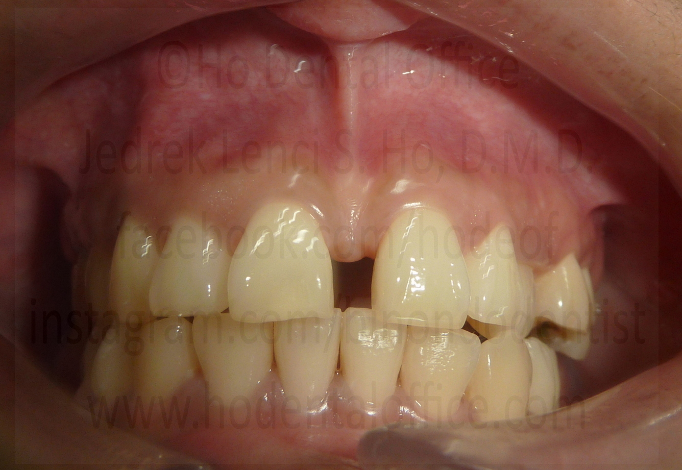 excessive frenum attachment on upper lip