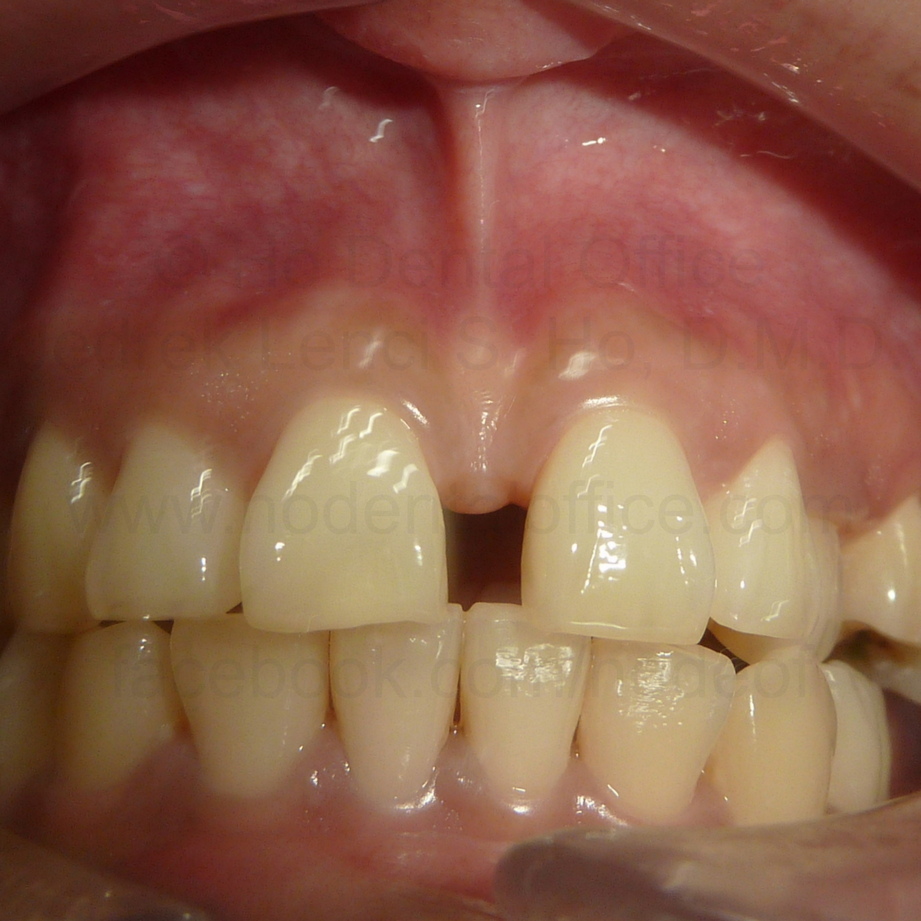 excessive frenum attachment on upper lip