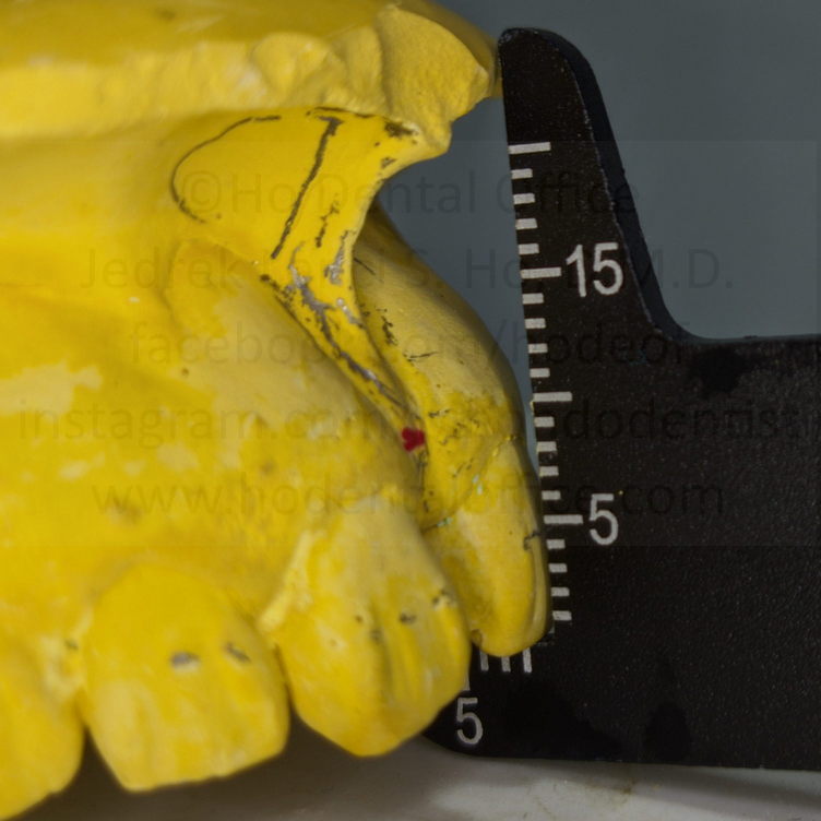 frenum attachment measurement from edge of incisor to main attachment point marked in red - around 9mm