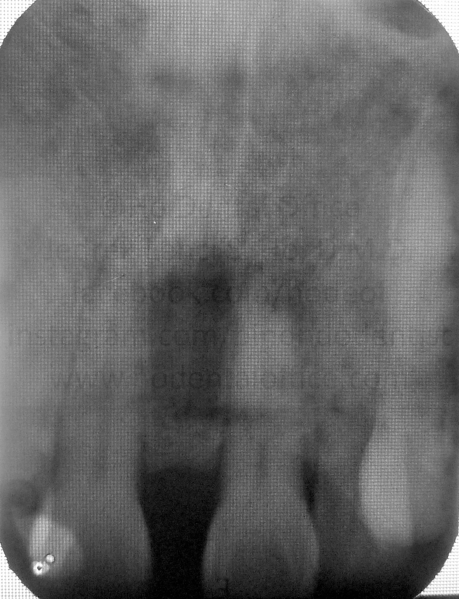 periapical x-ray shows no hidden teeth in the middle of the two incisors
