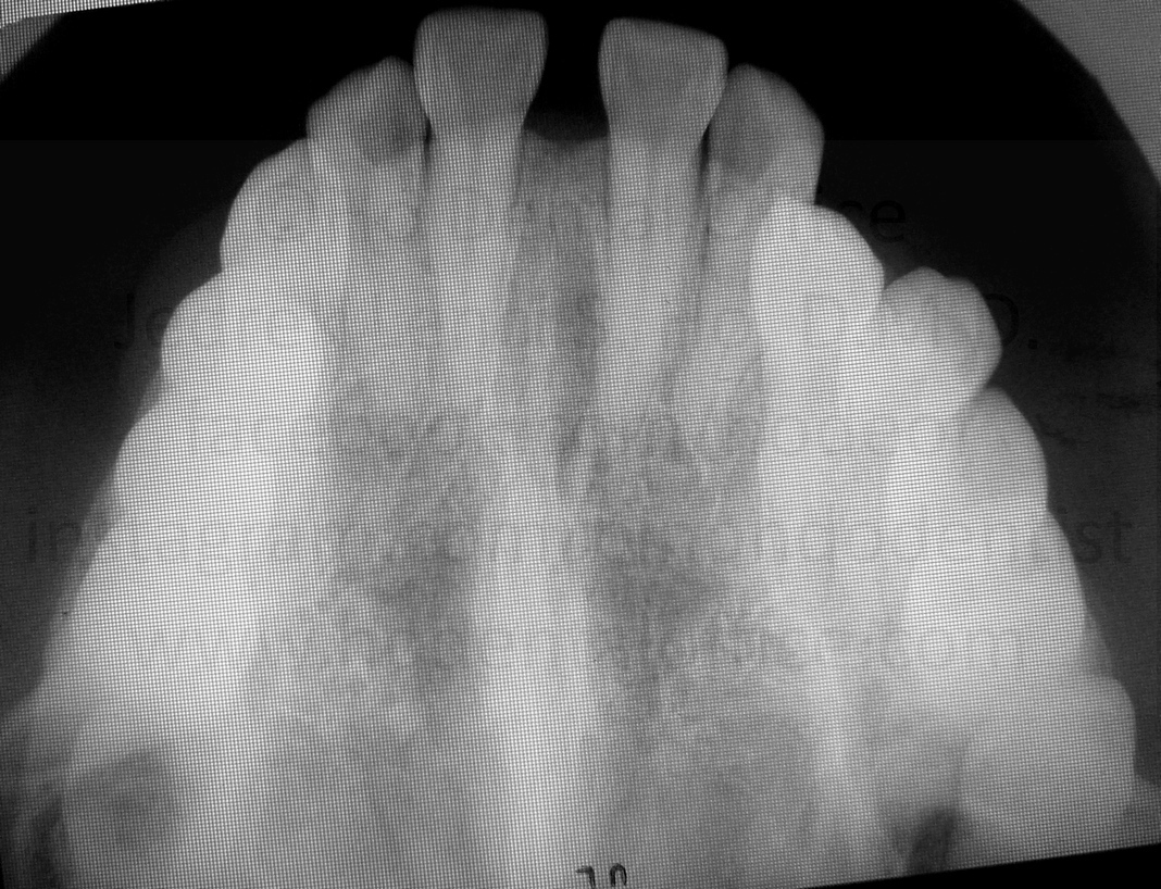 occlusal x-ray shows no hidden teeth in the middle of the two incisors