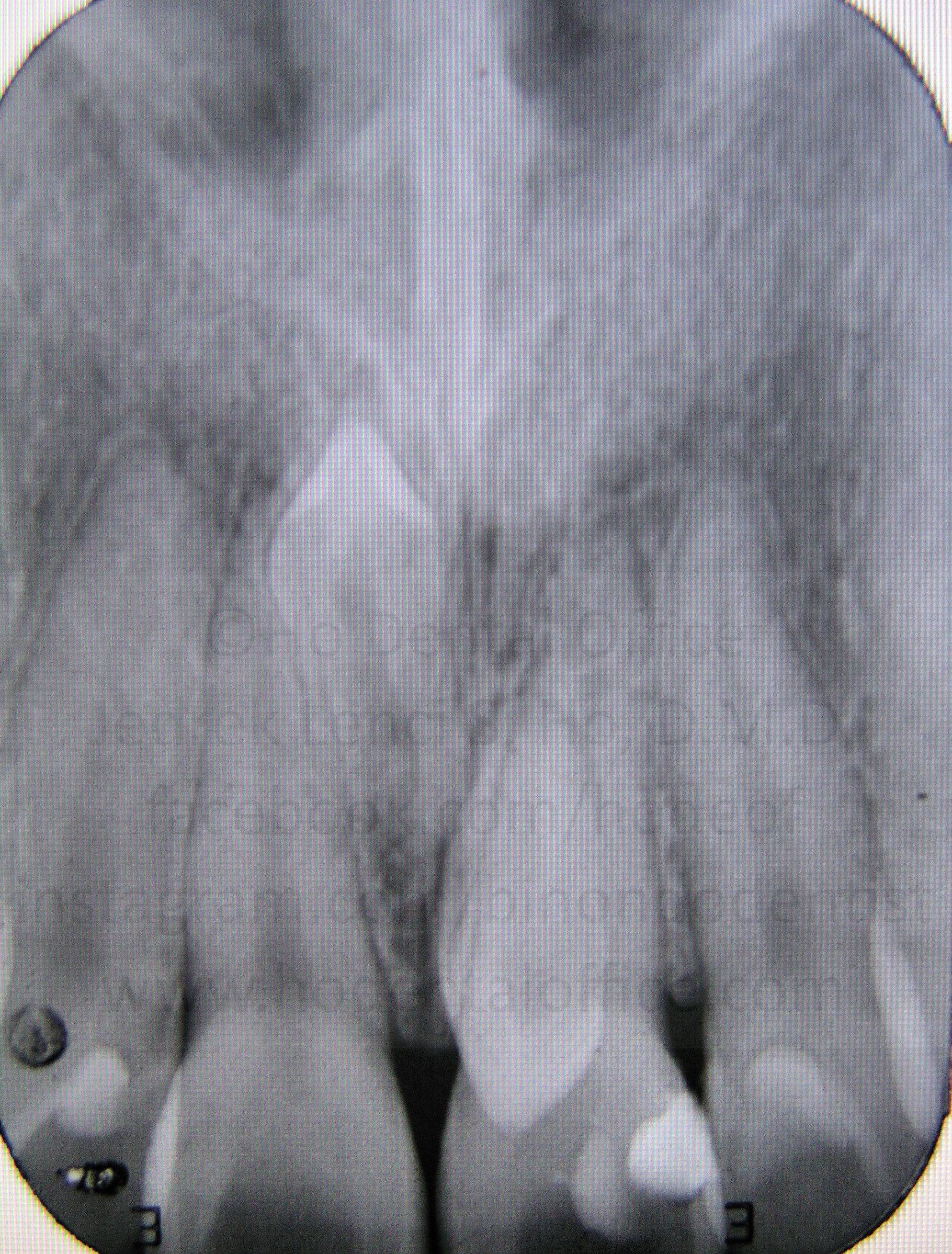 example of a mesiodens as seen on x-ray, or two