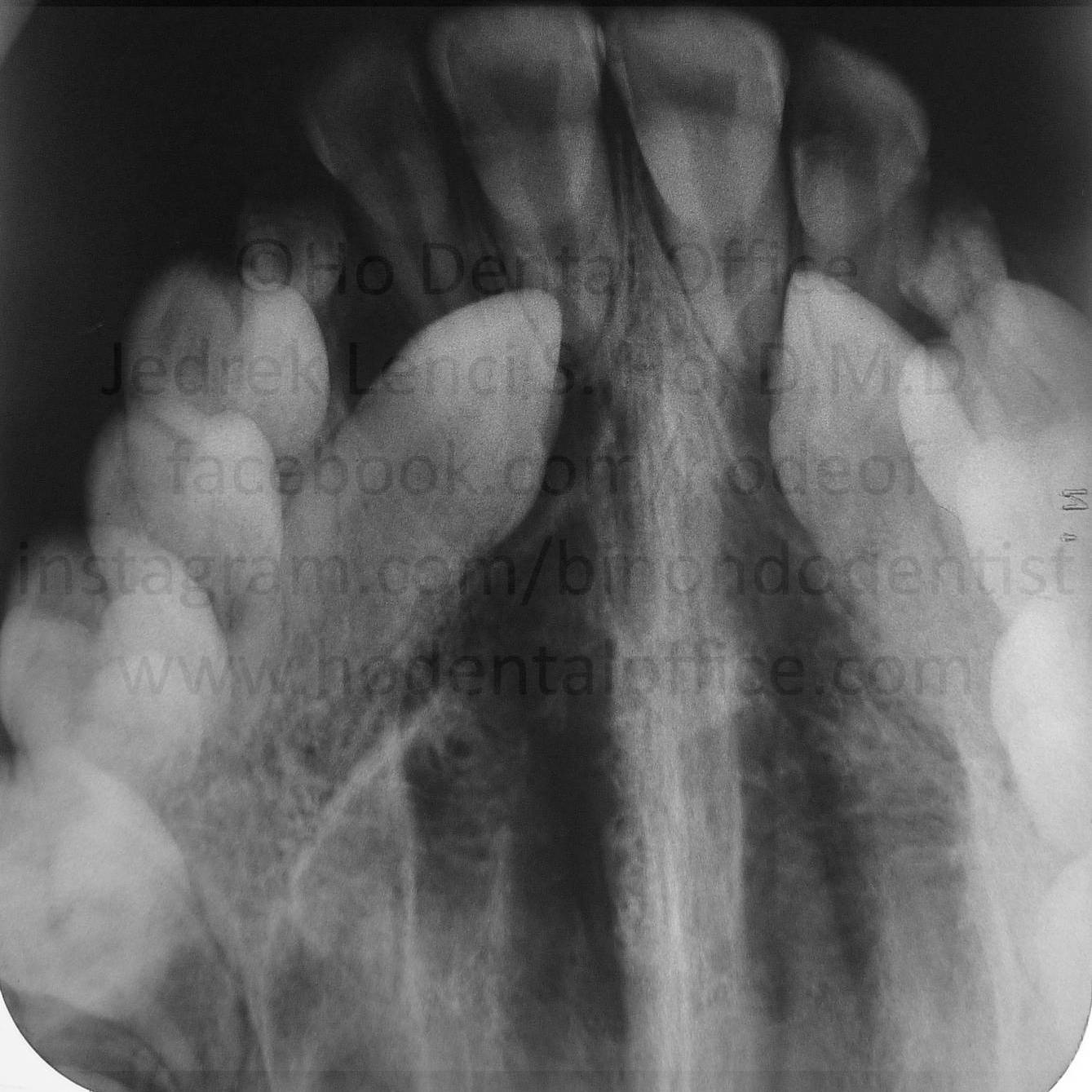 bilateral impacted upper canine