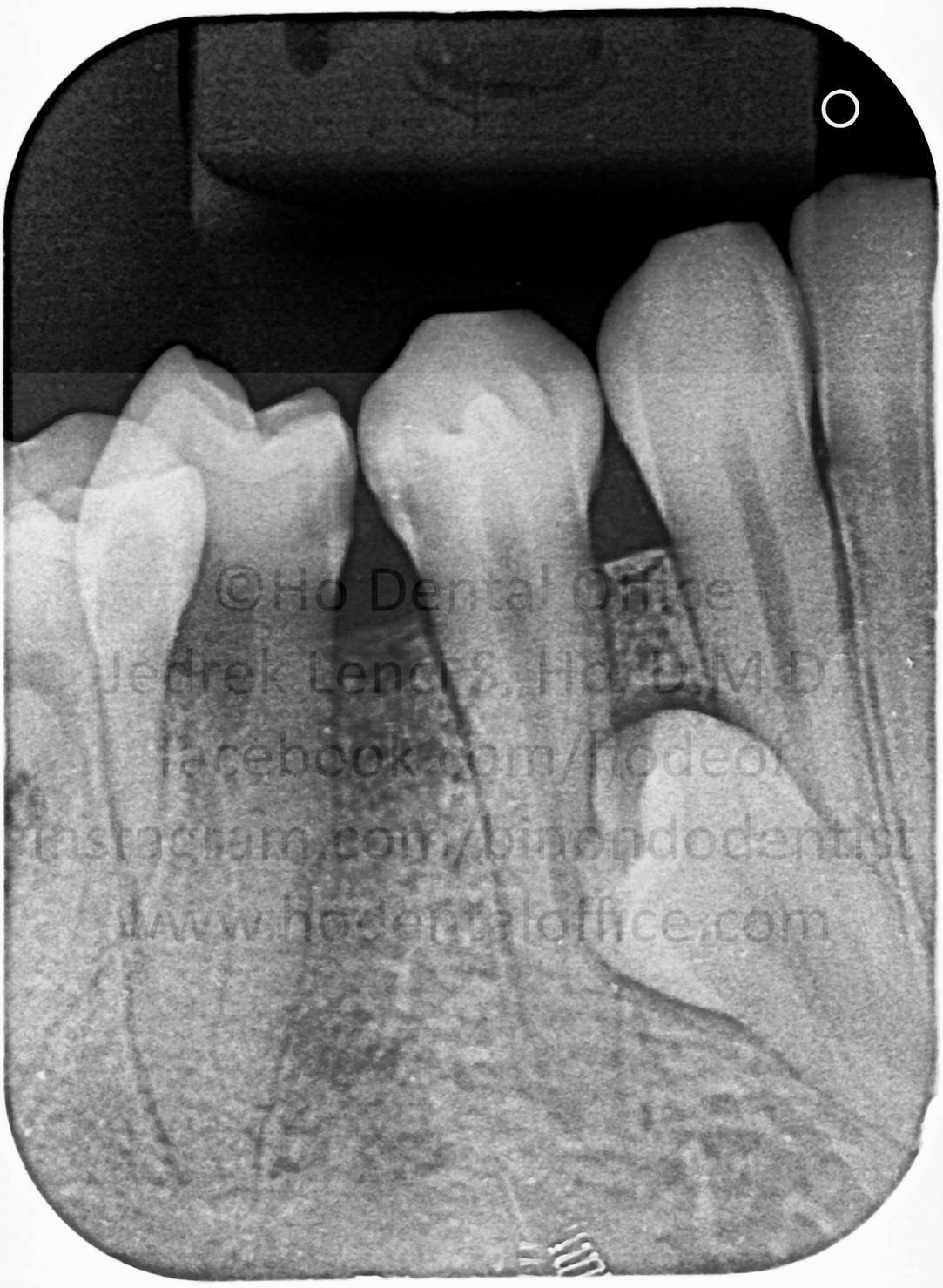impacted supernumerary lower premolar