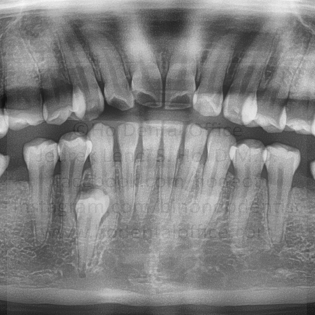impacted supernumerary lower premolar