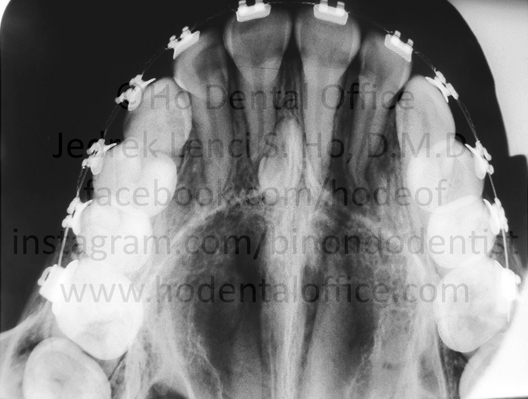 impacted supernumerary upper mesiodens