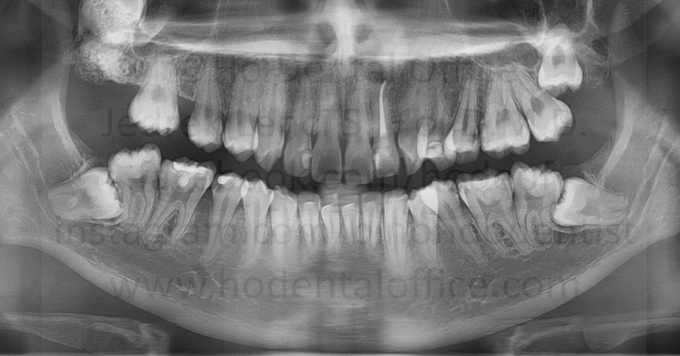 impacted upper and lower third molars (wisdom teeth)