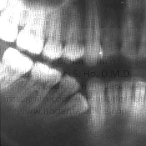 impacted lower first premolar