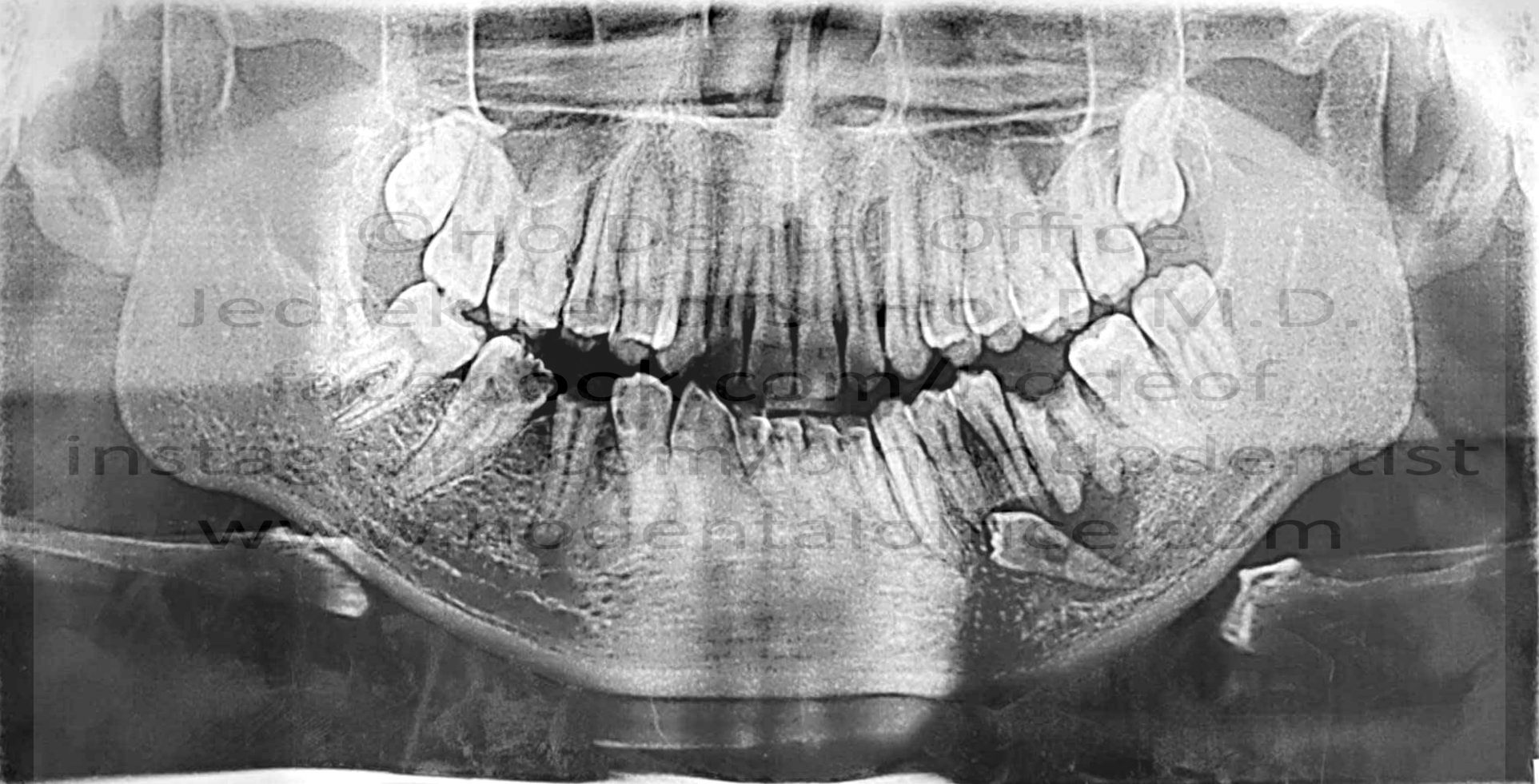 unidentified cyst growing around the lower left supernumerary premolar