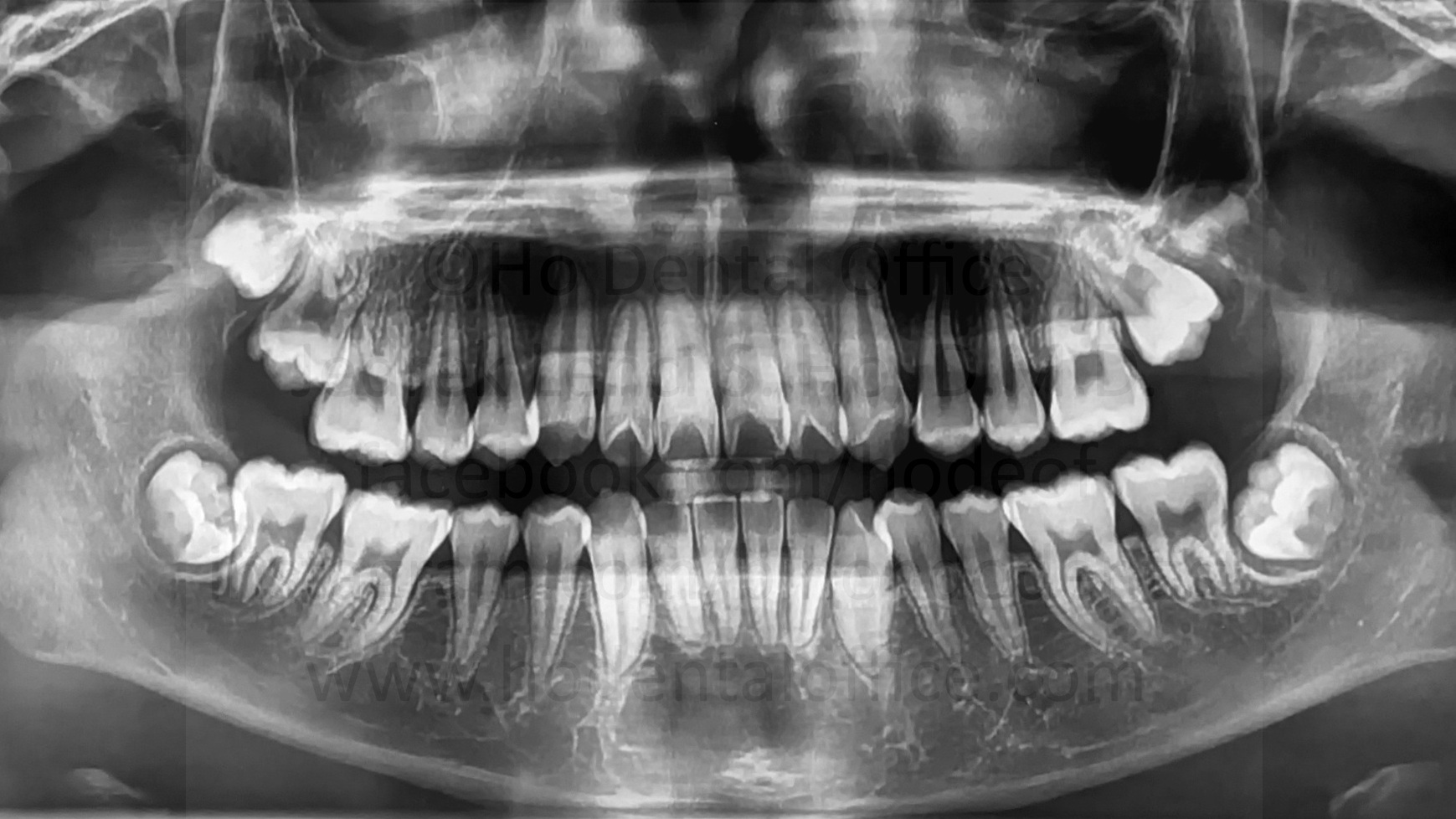 immature third molars from a 14y.o. patient - half matured lower third molars with crown almost fully formed and no roots formed yet
