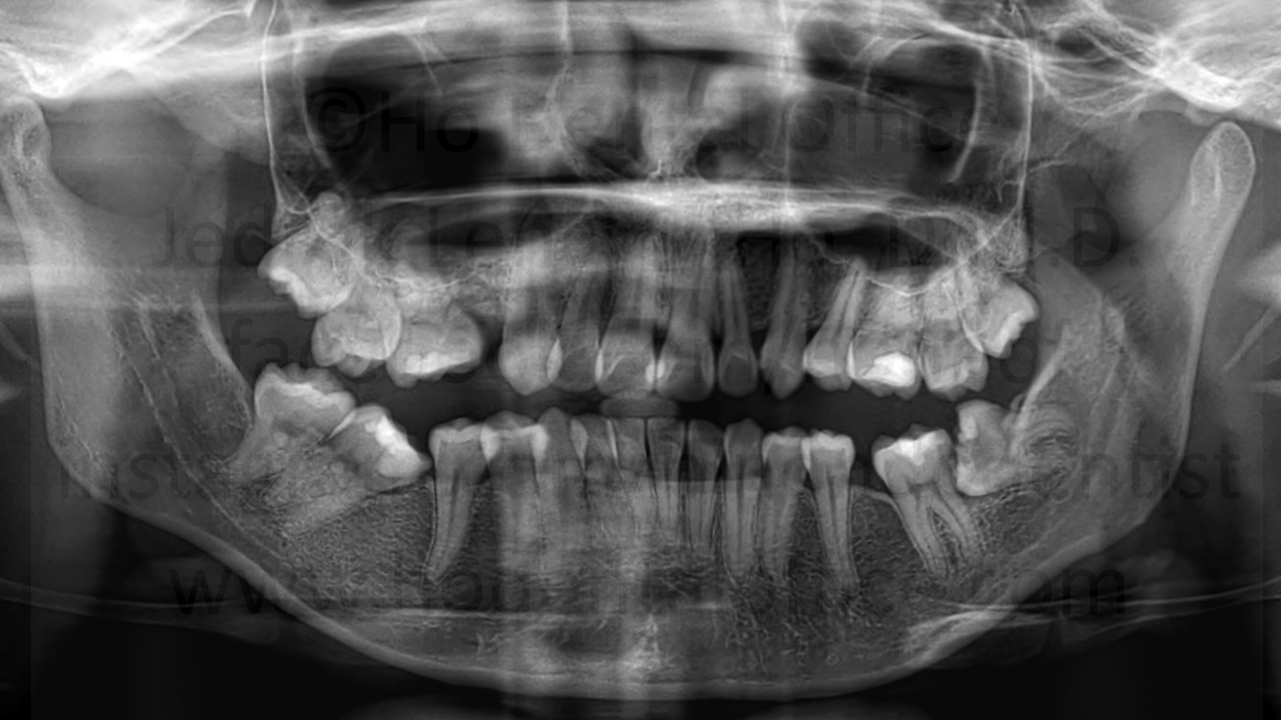 severe dental crowding exacerbated by presence of third molars