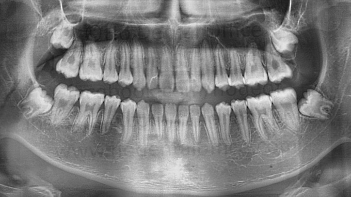 immature third molars from a 18y.o. patient - almost fully matured lower third molars with crowns fully formed and roots almost completely formed