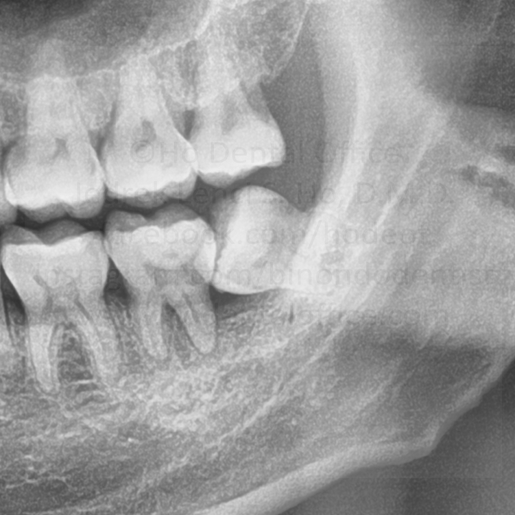 erupted part of third molar's crown possibly causing premature bite contact