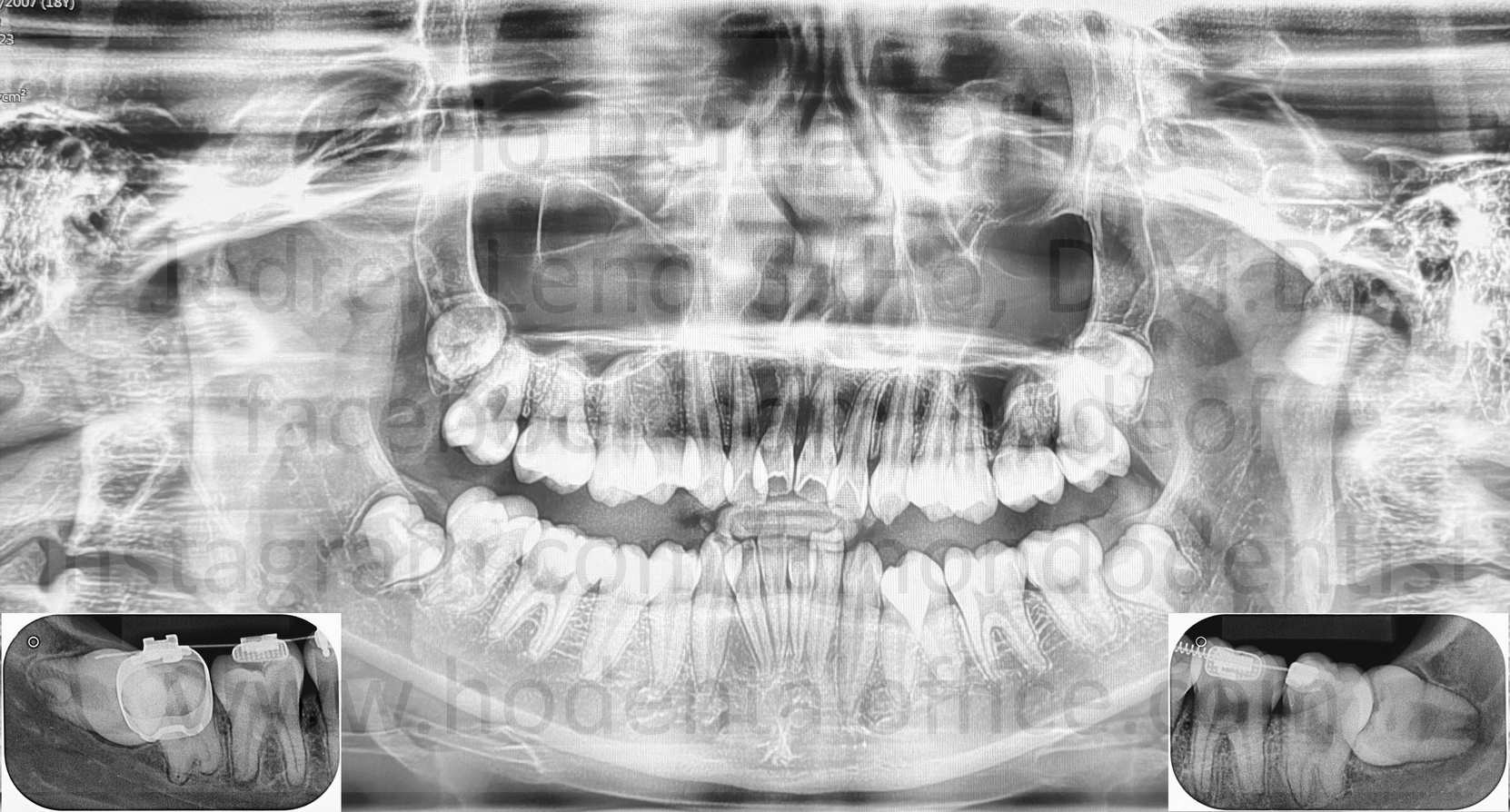 2023 panoramic x-ray with insets of 2025 x-rays from a patient with third molars - notice different positioning of third molar on 2023 (angled 45°) vs 2025 (angled 90° almost horizontal)