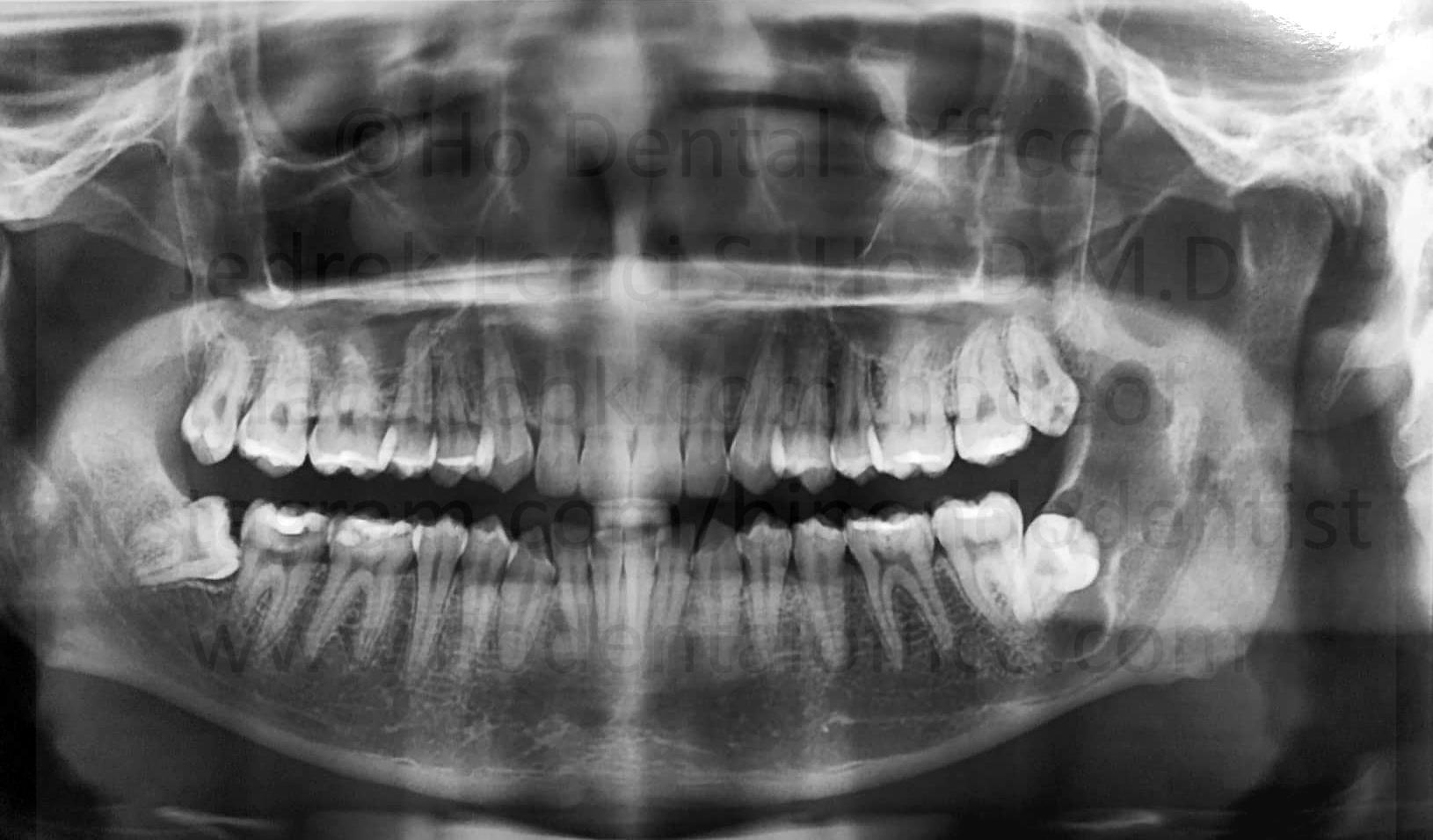 impacted lower third molars (wisdom teeth), one with a cystic lesion