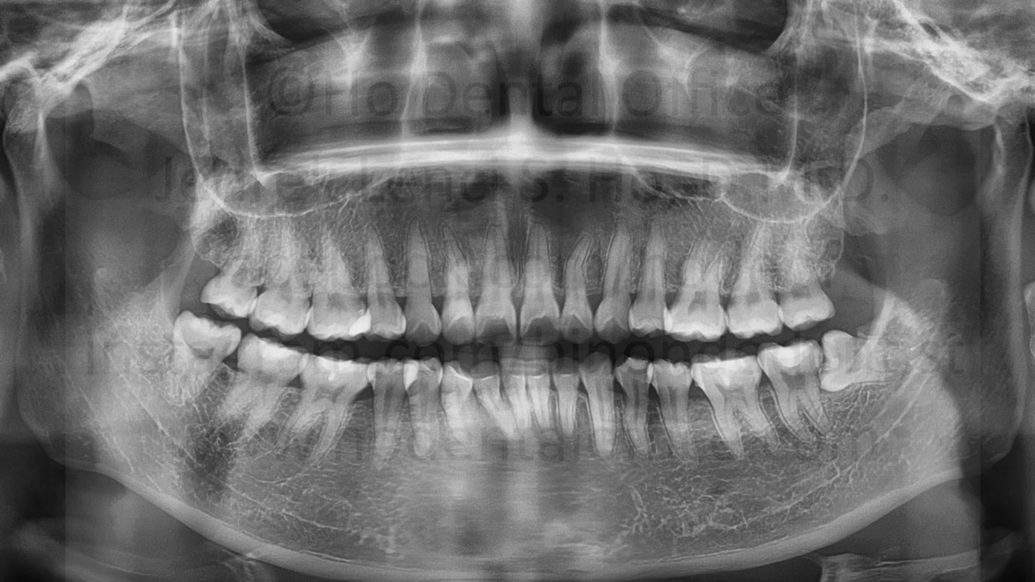 fully erupted lower right third molar possibly causing premature bite contact