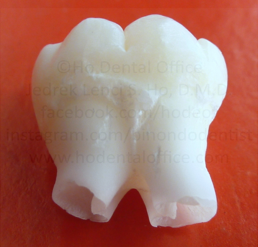 an immature lower third molar / wisdom tooth specimen