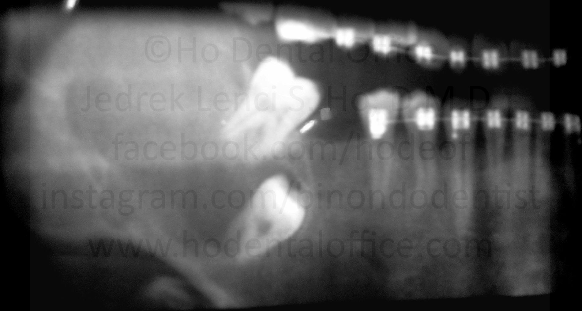 dentigerous cyst growing beneath the third molar