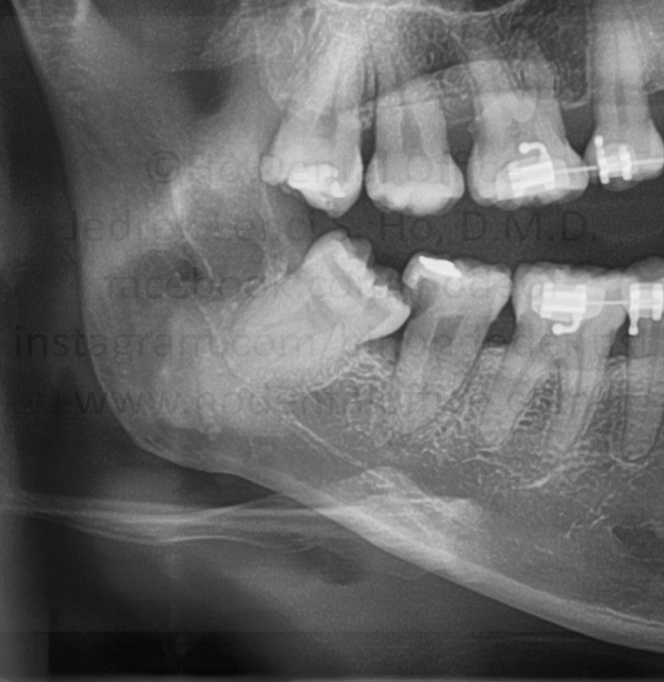  tooth decay on the lower second molar, beside the impacted wisdom tooth
