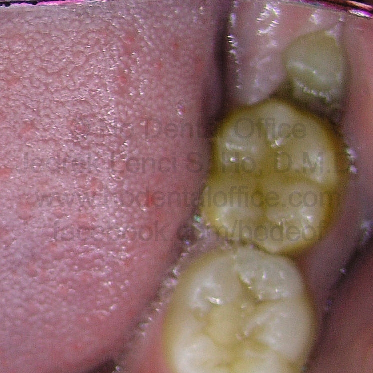 an operculum partially covering a third molar