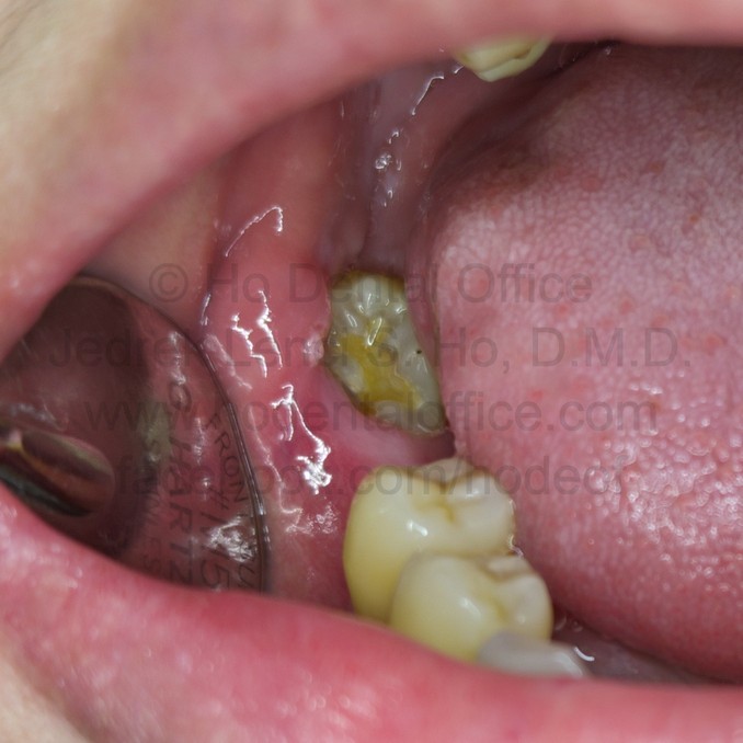 an operculum partially covering a third molar